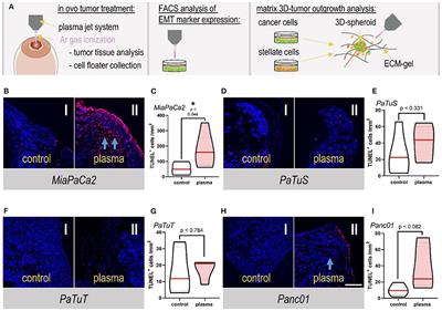 Risk Evaluation of EMT and Inflammation in Metastatic Pancreatic Cancer Cells Following Plasma Treatment